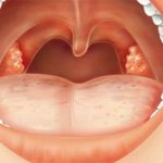 white lumps on tonsils