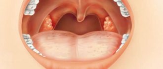 white lumps on tonsils