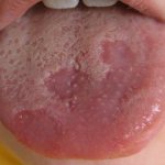 Plaque on the tongue due to gastrointestinal diseases
