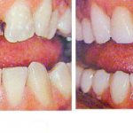 Teeth extension before and after
