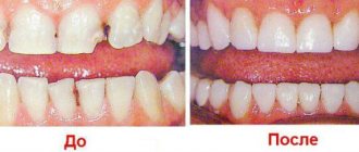 Наращивание зубов до и после