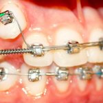 External braces are one of the main (for now) methods of correcting malocclusion in adults.