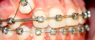 External braces are one of the main (for now) methods of correcting malocclusion in adults.