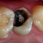 Do not hope that with pulpitis the pain will disappear on its own, because even if this happens, the pulp will rot right in the tooth.