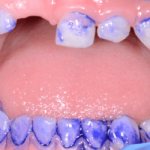 You can&#39;t silver permanent teeth - Summer