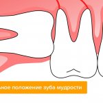 Incorrect position of wisdom teeth in pictures