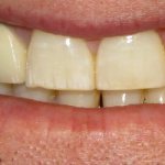 Uneven surface of teeth - Smile Line Dentistry