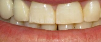 Неровная поверхность зубов - Стоматология Линия Улыбки