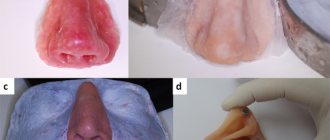 Nasal prosthesis. a) wax cast; b) polymerization; c) coloring; d) installation of magnets 