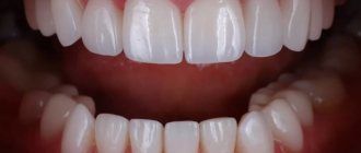 Typically, restoration with veneers is carried out only in the smile area - these are 10 upper and 8-10 lower teeth