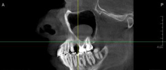 Odontogenic cyst on x-ray