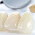 Описание, виды и назначение временных зубных протезов