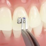 Basic calculations for high-quality fixation of braces