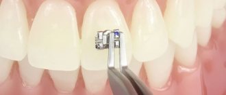 Basic calculations for high-quality fixation of braces