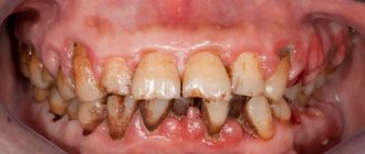 Osteoplastic materials for the treatment of periodontitis