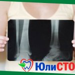 Osteoporosis - detection on x-rays