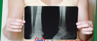 Остеопороз - выявление на рентгеновских снимках