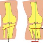 Osteotomy of the knee joint