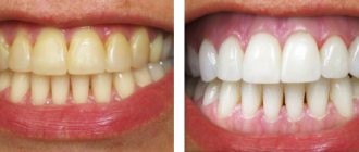 Opalescence whitening before and after photos