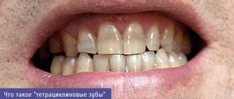 Tetracycline teeth whitening