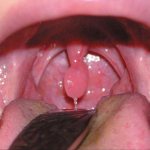 Swelling of the uvula