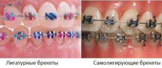 Differences between braces