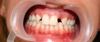 Absence of upper incisors