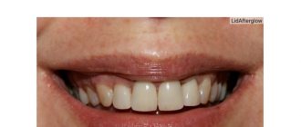 Reviews for Emax crowns (Emax)