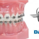 Reviews from specialists and patients about Damon Q braces