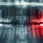 panoramic photo of teeth according to compulsory medical insurance