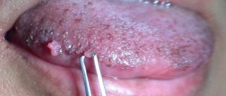 Papillomas on the tongue are caused by constant trauma to the mucous membrane and/or HPV infection