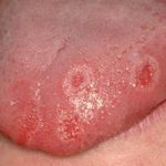 papules on the tongue