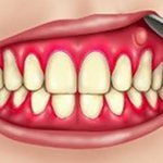 periodontal abscess article