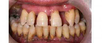 severe periodontitis