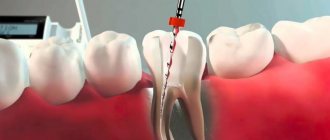 Root canal retreatment