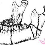 types of mandibular fracture