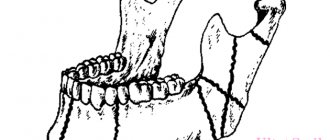 перелом нижней челюсти виды