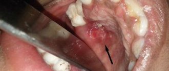 Perforation of the hard palate in tuberculosis