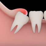 Перикоронит зуба мудрости: симптомы, причины, лечение