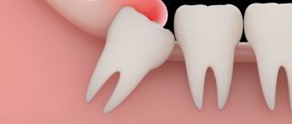 Wisdom tooth pericoronitis: symptoms, causes, treatment