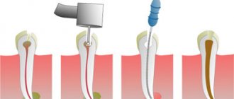 Periodontitis treatment methods