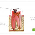 periodontitis of the tooth