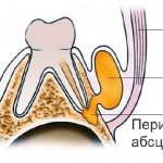 Periostitis is an inflammatory process in tooth tissues
