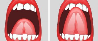 Plastic surgery of the frenulum of the tongue in pictures