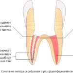 root canal filling using a combination of silver plating and resorcinol-formalin method
