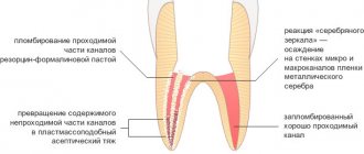 root canal filling using a combination of silver plating and resorcinol-formalin method