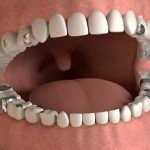 Filling teeth in dentistry with amalgam