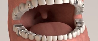 Пломбирование зубов в стоматологии амальгамой