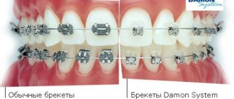 Why do Damon braces come off faster than regular braces?