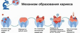 Почему гниют зубы у взрослых